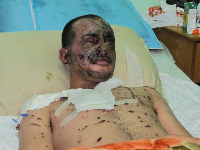 Moath Nofal Abo El-Eash, 20 - Moath has injuries from burns all over his body, particularly on his face and splinters in several parts of his body.